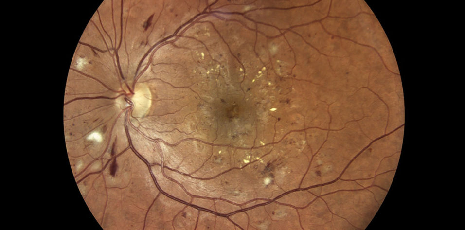 kezelése retinopathia diabetes